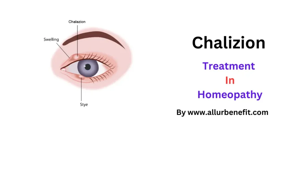 Chalazion And It's Homeopathy Treatment.